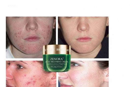 Crème Anti - Acné à l’Arbre à Thé – Zenora Skin Balance - Zenora